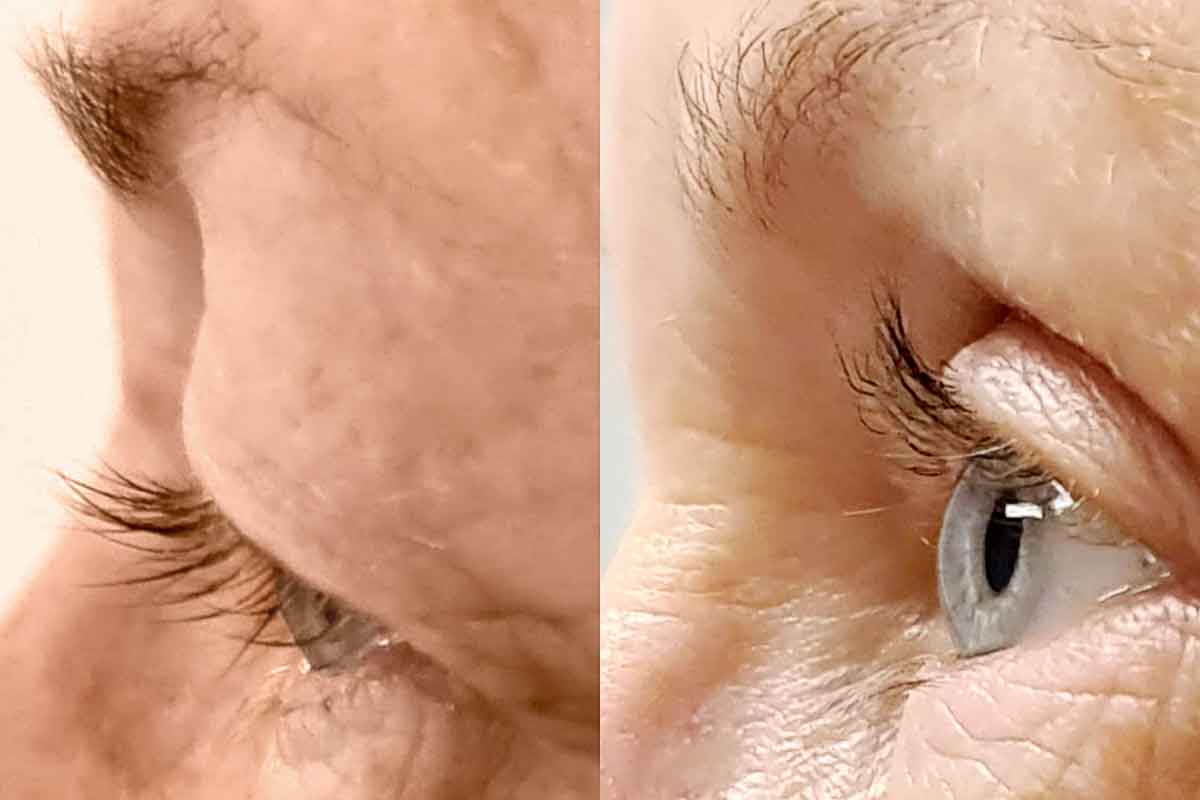 Ögonlocksoperation före och efter